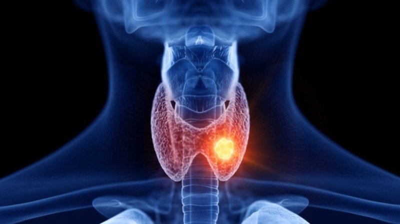 Thyroid cancer risk factors